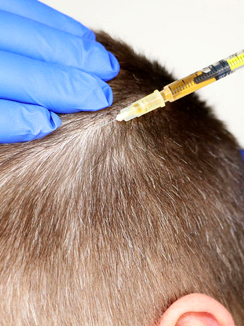 Female Hair Loss Treatment Liverpool | Aesthetically You
