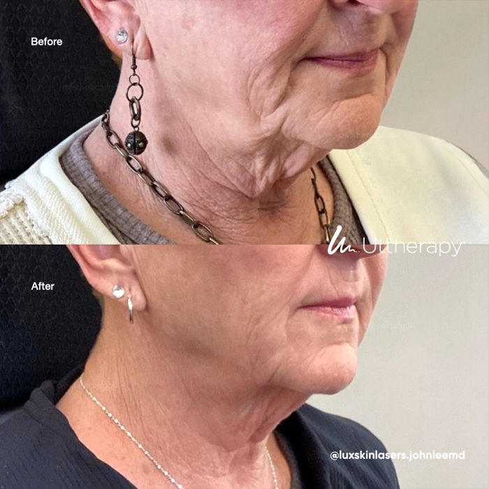 aestheticallyyou-ultherapy-beforeafter01