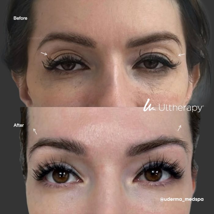 aestheticallyyou-ultherapy-beforeafter02