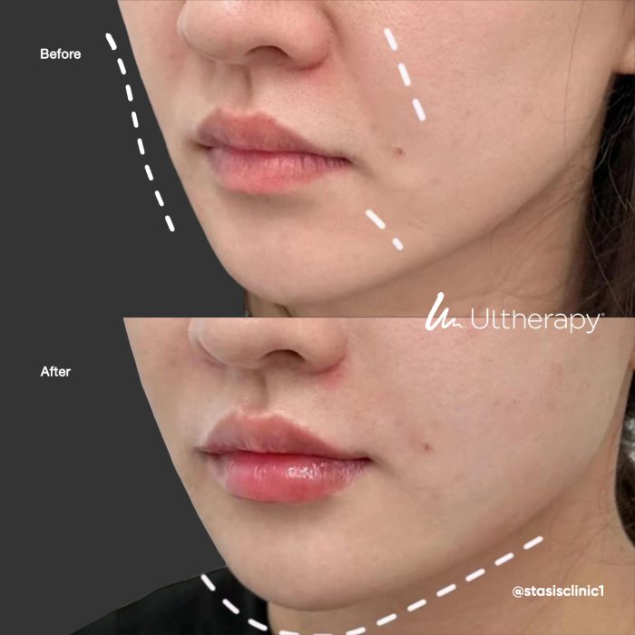 aestheticallyyou-ultherapy-beforeafter03
