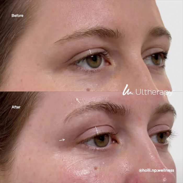aestheticallyyou-ultherapy-beforeafter04