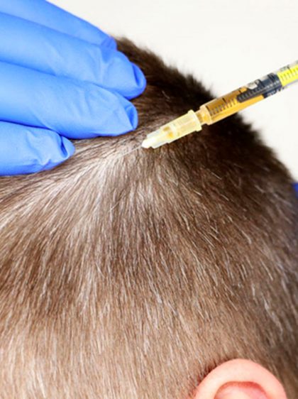 Hair Growth Plasma Injections Liverpool | Aesthetically You